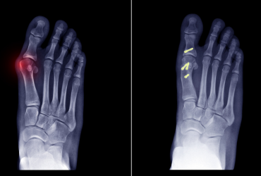 Managing Foot deformities